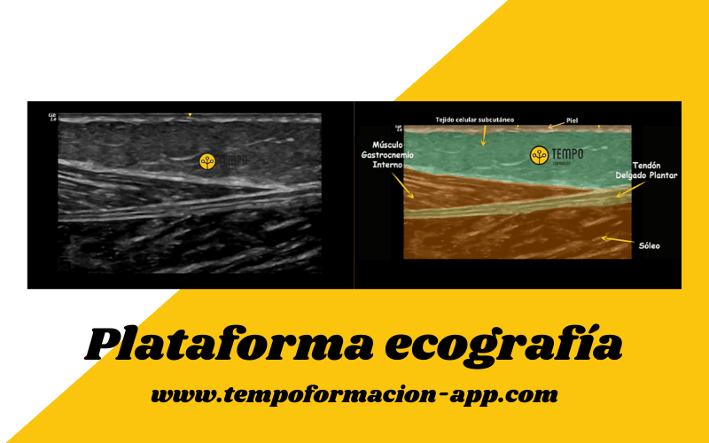 2. Preguntas y respuestas ecografia fascitis plantar delgado plantar osgood schlatter.png